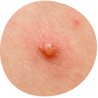 pox-2
